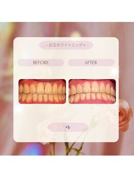 プラスビー 2号店(+b)/ホワイトニングビフォー