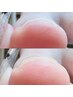 【巻き爪の方】巻き爪ケア(親指1本)