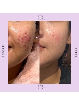 キー バイ マグラフ 南松本店店(KYE by Mag R.A.F)/エクソリフトで赤みを抑える