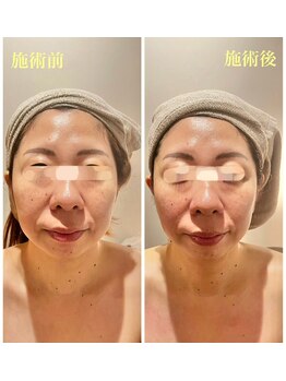 ルネ(Lune)/新★小顔フェイシャル