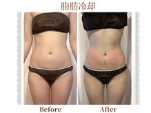 モテスリム/脂肪冷却 お腹2カップ