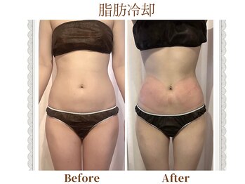モテスリム/脂肪冷却 お腹2カップ