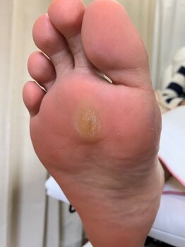 ランカ(RUNKA)/ヒールでできたタコ