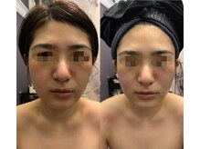 ナラビューティー(NARA BEAUTY)/コルギ2回効果