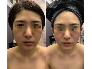 ナラビューティー(NARA BEAUTY)/コルギ2回効果