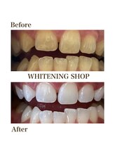 ホワイトニングショップ 恵比寿店/【Before　After】