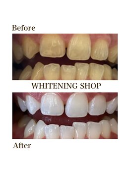 ホワイトニングショップ 恵比寿店/【Before After】