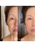 《究極エイジングケア》【ダブルヒト臍帯幹細胞上清液】あらゆる肌悩みに☆