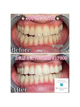 ホワイトニングビューティー 吉祥寺店/症例写真_2回来店されたお客様