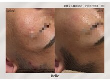 ベル 新橋(Belle)/ハーブピーリング×毛穴洗浄