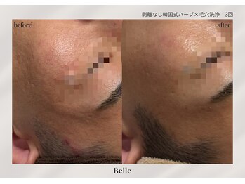 ベル 新橋(Belle)/ハーブピーリング×毛穴洗浄