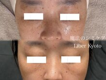 エステティック リベル キョウト 京都駅前店(Esthetic Liber Kyoto)/魔法のシミケア
