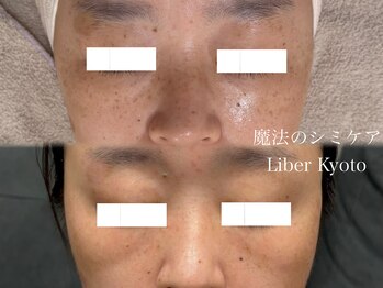 エステティック リベル キョウト 京都駅前店(Esthetic Liber Kyoto)/魔法のシミケア