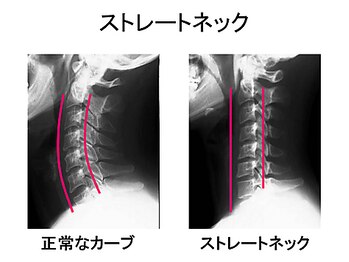 一善整骨院/ストレートネックの改善も簡単