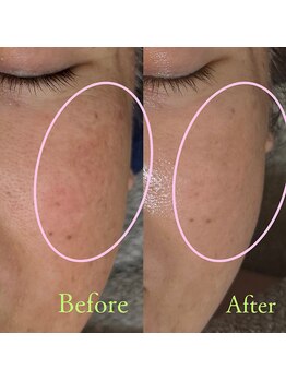 ザ レディービー(The Lady B)/シミ改善