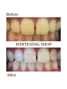 ホワイトニングショップ 恵比寿店/【Before After】