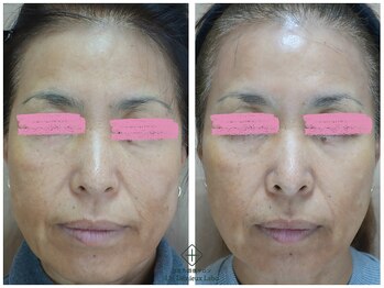 アンレミューラボ(Un Lemieux Labo)/シワ、たるみ、くすみ改善