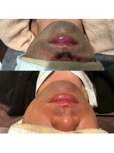 サロン クベル(Salon Kvell)/ヒゲ脱毛