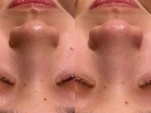 ビュップ 鶴ヶ峰店(美up)/毛穴レス