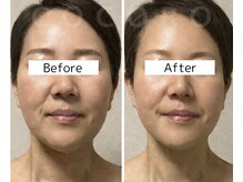 ココロ(COCORO)/エステ版サーマジェン×EMS