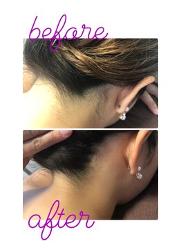 ツリービューティー(Tree Beauty)/★うなじ脱毛★