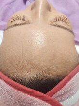 キアラ 麻布十番(Kiara)/顔脱毛　ブラジリアンワックス