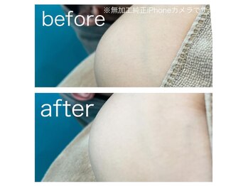 ラクシー 北千住(luxssy)/肩シェービング