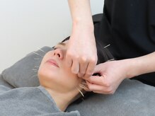 お顔のコリや緊張を緩め自律神経のバランスを整える顔鍼