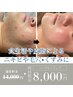 《ハーブピーリング》夏肌ストレス解消♪皮脂/開き黒ずみ毛穴/ざらつき