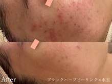 サロンヴェアリー 広尾(salon vary)/ニキビ後のケア、凹凸
