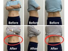 Noa接骨院 はりきゅう院/脂肪冷却　B/A写真