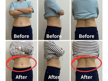 Noa接骨院 はりきゅう院/脂肪冷却 B/A写真