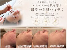 アンリミット 代々木上原店(Une limit)の雰囲気（話題【乳酸菌ピーリング】乾燥ケア◎敏感/赤み/代々木上原）