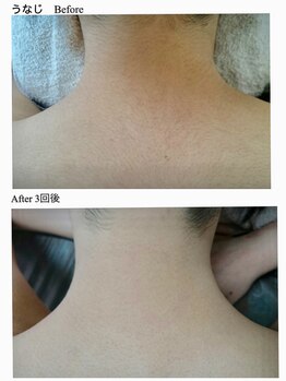 ヴィオール 名古屋栄店(VIOR)/レディース脱毛】　うなじ