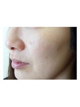 アイビー(IVY.L)/光フェイシャル