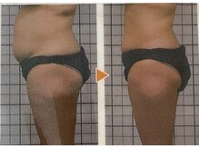 エステティックジュネス(JEUNESSE)/スーパースリム