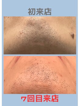 トゥルー(true)/ヒゲ脱毛　経過写真