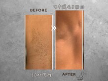 ル シャ/メンズ脱毛/毛穴洗浄/ヘッドスパ