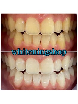 ホワイトニングショップ 山形店(Whiteningshop)/笑顔を褒められる