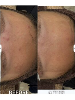 ビーユープロデュースバイエイチ(Be you produced by H)/ビフォーアフター