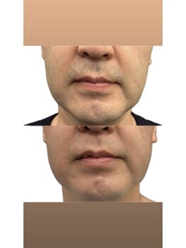 ハク(HAKU)/脱毛before→after