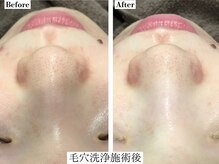 フレイヤ(FREYA)/毛穴専科Before→After