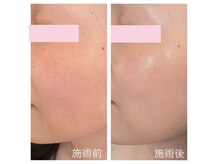 オリジナル小顔調整＆美肌ケアは骨格、コリから整えていきます