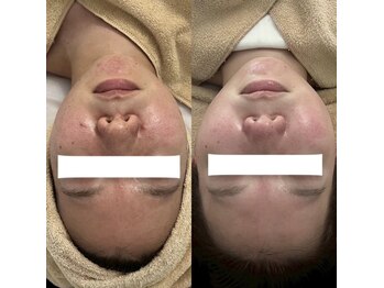 サロン アイプラス(salon i plus)/ニキビ/毛穴開き