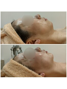 ルノン(Lunon)/《整顔》winbackフェイシャル