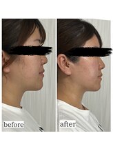 エミニーライフ(EMINY LIFE)/1回でも横顔スッキリ♪