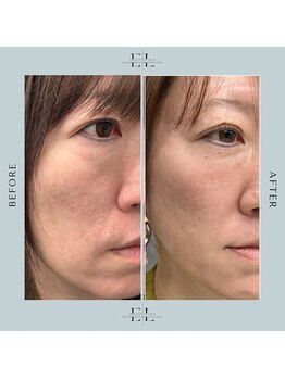 ビューティサロン ダブル 三田店(beauty salon W)/エクソリフト