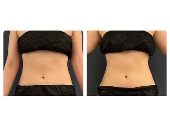 インディバサロン(INDIBA SALON 8296)/1度の施術で！