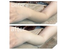 ラクシー 北千住(luxssy)/腕シェービング