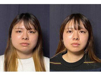 美容整体 アルマ/頭を柔らかく→顔が引き締まる！